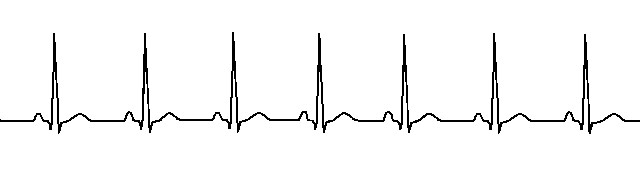 What is a PVC Heart Beat